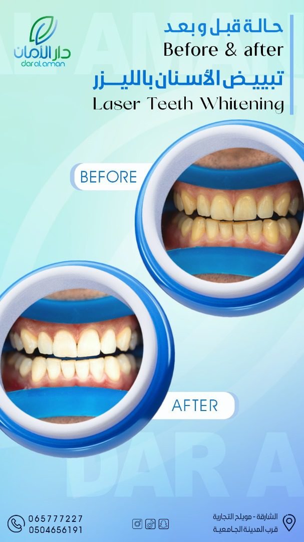 Laser teeth